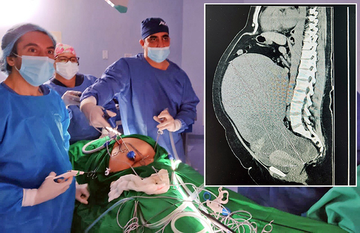realizan-cirugia-para-extraccion-de-tumor-gigante-con-exito-en-hospital-iess-ceibos-ecuador221.com_.ec_ Realizan cirugía para extracción de tumor gigante con éxito en hospital Iess Ceibos