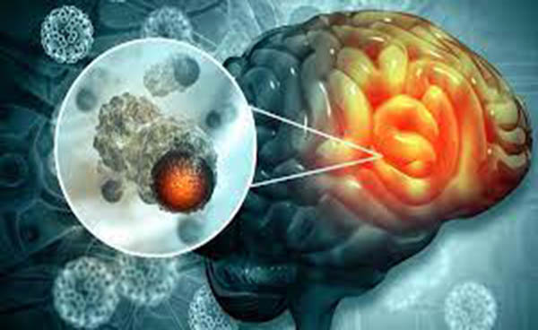 hoy-es-el-dia-internacional-de-los-tumores-cerebrales-ecuador221.com_.ec_ Hoy es el Día Internacional de los Tumores Cerebrales
