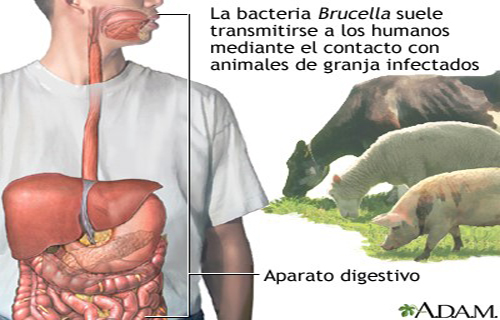 Casos de Brucelosis