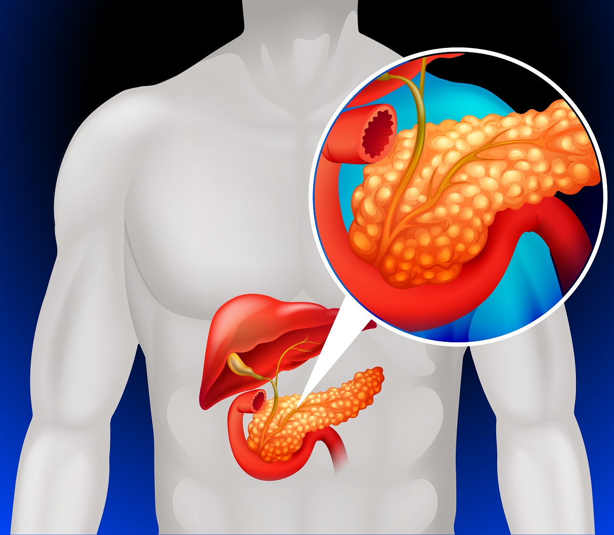 pancreas-foto El Cáncer de Páncreas una enfermedad muy  agresiva en el mundo