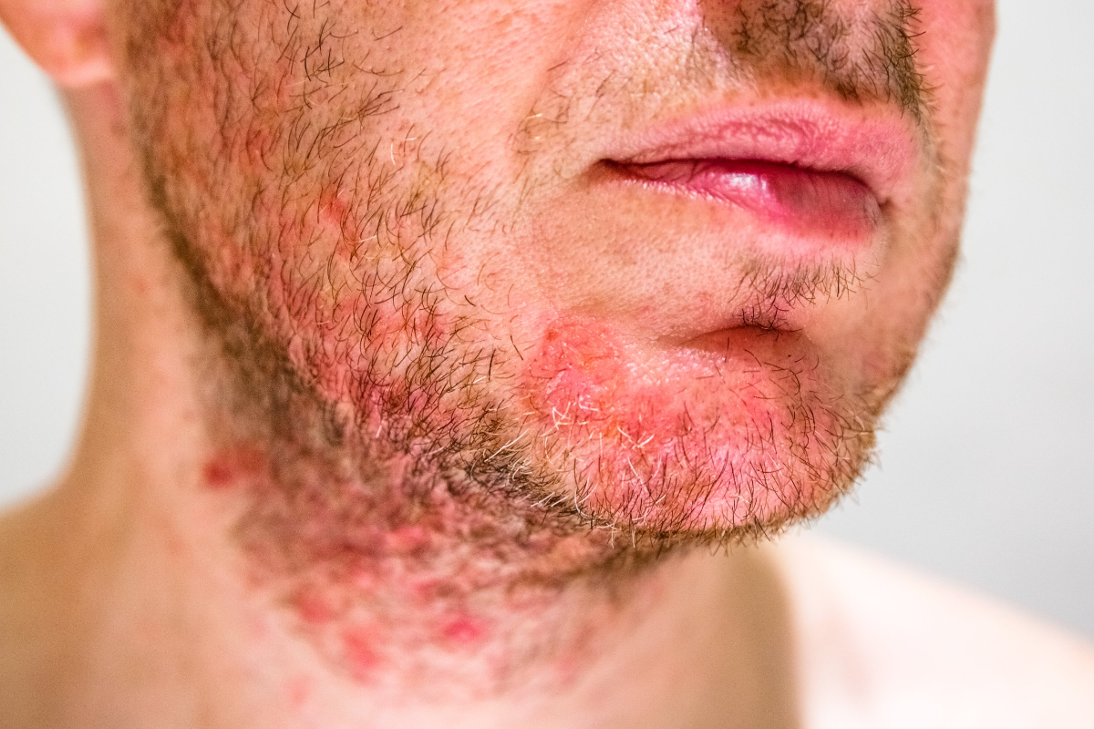 ecuador 221 foliculitis-foto-cortesia Foliculitis: La inflamación de los folículos pilosos que debes conocer