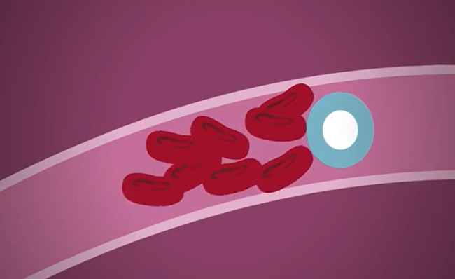 ecuador 221 hoy-se-celebra-el-dia-mundial-del-ictus-ecuador221.com_.ec_ Hoy se celebra el Día Mundial del Ictus