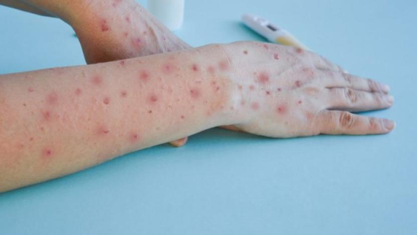 ecuador-confirma-primer-caso-de-nueva-variante-mpox.ecuador221.com_.ec_ Ecuador confirma primer caso de nueva variante Mpox